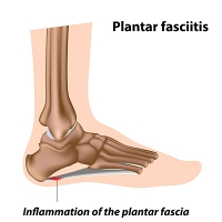 Pain Can Be Severe in the Morning With Plantar Fasciitis